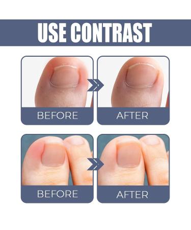 German Toenailcare Removal Paronychia Oil - 2 Pcs Set for Ingrown Toenail Treatment and Softening Embedded Toenails - Buy Online on GoSupps.com