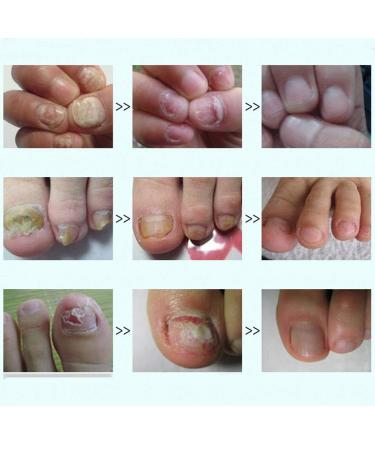 Allbesta Enzymatic Gel & Repair Film Toe Nail Rescue Set Ultimate Nail Care for Healthy Nails & Cuticles - Buy Online on GoSupps.com
