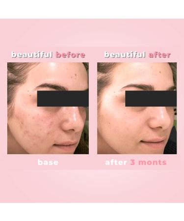 3 Steps Anti Blemishes Set for Healthy Skin No Spots No Breakouts Suitable for Pimples and Blackheads Regulates Oiliness Visible results within 14 days - Buy Online on GoSupps.com
