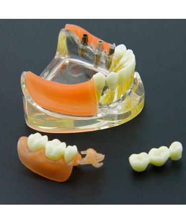 Dental Implant Restoration Teeth Model Removable Bridge Denture Demo for Teaching Study and Patient Education