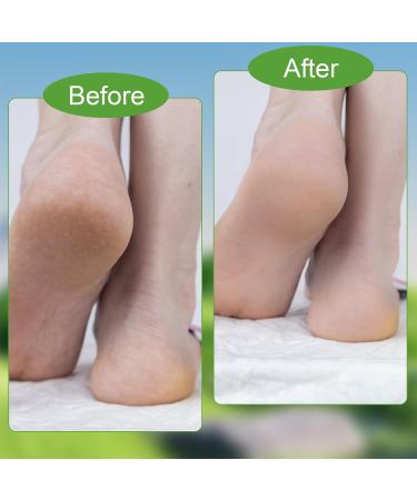 Urea 42% Foot Cream Avocado Urea Cream for Deep Cracked Skin Deep Moisturizing Cracked Heel Repair Cream with Hyaluronic Acid Tea Tree and Aloe Vera Callus Remover - Buy Online on GoSupps.com