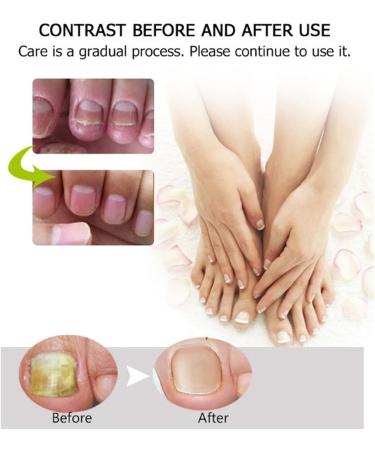  DUBUSH Narc Paronychia Repairing Nail Care Gel restores the appearance of discolored or damaged nails. Instant beauty gel. - Buy Online on GoSupps.com