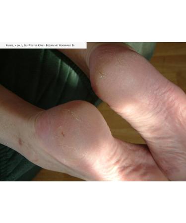 Natural Products Black Callus Ex - Effective Callus Remover & Foot Cream 100ml | Fast International Shipping - Buy Online on GoSupps.com