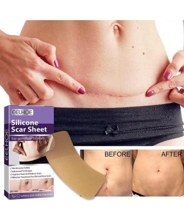 WAITLOVER Skin Color Reusable Silicone Scar Removal Patch - Surgical Self-Adhesive Soft Gel Strip for Burn Repair - Buy Online on GoSupps.com