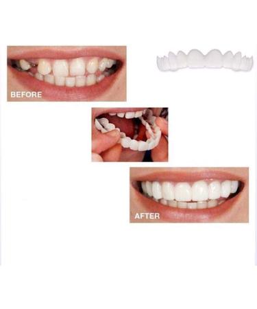 BGZ 5 Couples Perfect Smile Teeth Veneers - Instant Snap-On Dentures for Flawless Smile | Temporary Braces for Imperfect Teeth (5 Upper & 5 Lower) - Buy Online on GoSupps.com