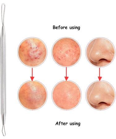 Acne Needle Stainless Steel Comedone Acne Blackhead Remover Needles Pimple Blemish Black Dots Skin Face Care Tools Clip Spoon Kit (Color : Peach) - Buy Online on GoSupps.com