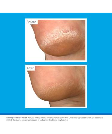 O Keeffe s Healthy Feet Overnight 5 x 80ml Tubes Intensive Foot Cream for Extremely Dry Cracked Feet | Visible Results in 1 Night 5 Count (Pack of 1) - Buy Online on GoSupps.com