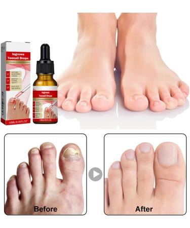 Ingrown Toenail Treatment Drop Ingrown Toenail Treatment Ingrowth Toenail Correction Treatment Oil Correction Ingrown Toenail Drops Cuticle Care Oils For Ingrown Toenails Fungal Toenail Treatment - Buy Online on GoSupps.com