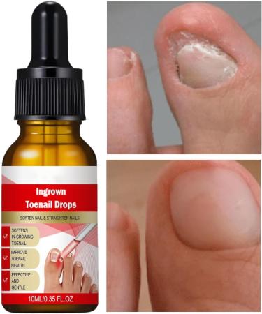  TQEBWUS Nail and Toenail Strengthening Liquid - 10ml Ingrown Toenail Corrector Drops Beauty Care for Hands and Feet Nighttime Travel Treatment for Dry Damaged Cracked Curved Fragile and Chipped Nails - Buy Online on GoSupps.com