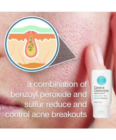 CONTROL CORRECTIVE Clear Med 10% Acne Treatment Lotion - 2.5 Oz | Benzoyl Peroxide & Sulfur Formula for Breakouts | Kills Acne Bacteria, Dries Blemishes - Buy Online on GoSupps.com