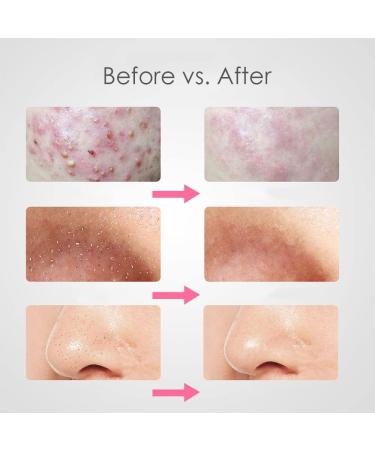 Piuruf Acne Needle Set - 7pcs Blackhead Remover Tool for Black Spots & Pore Cleansing | Comedone Extractor & Pimple Vacuum | Best Beauty Remote Tools - Buy Online on GoSupps.com