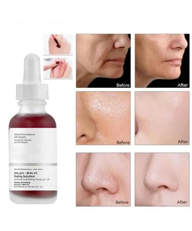 Peeling Solution 30ML | AHA 30% + BHA 2% Anti Acne Serum | Exfoliating Facial Serum for Pore Congestion & Fine Lines | 1 PCS - Buy Online on GoSupps.com