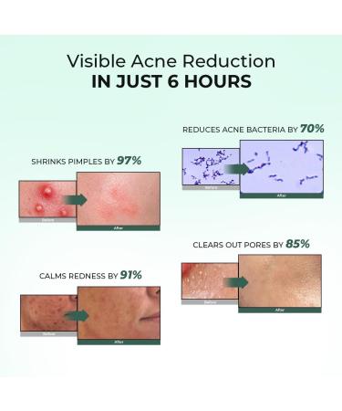 C.o.n.s.c.i.o.u.s C.h.e.m.i.s.t Rapid Relief Acne Spot Corrector Gel Salicylic Acid Azelaic Acid Sulfur 6 Hours 15ml - Buy Online on GoSupps.com