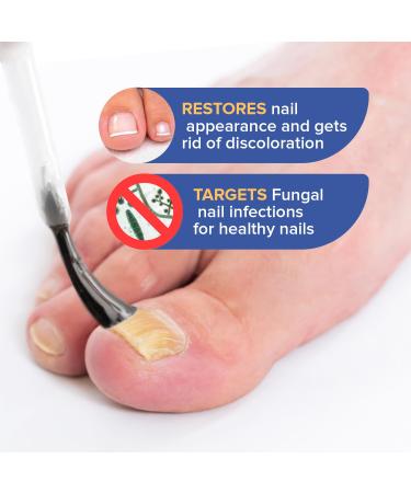 Extra Strength Toenail Fungus Treatment - 1% Tolnaftate for Discolored Nails & Athlete's Foot (30ml) - Fast-Acting OTC Formula - Buy Online on GoSupps.com
