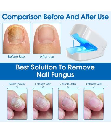 Buy Gobesty Light Therapy Device for Nail Fungus - Portable Cold Laser Treatment | Fivfivgo Anti-Fungal Solution - Buy Online on GoSupps.com