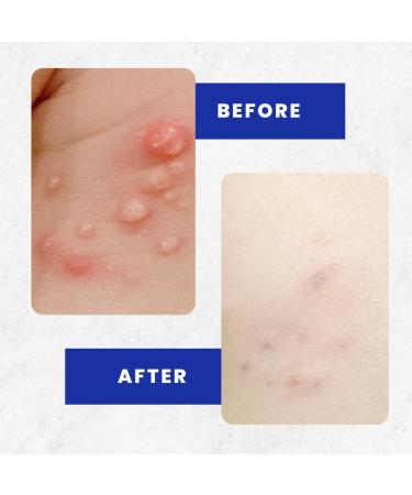 Hydrogel Skin Patches - Smooth Bumps & Hydrate | Dermatologist-Invented | 48 Patches for International Shipping - Buy Online on GoSupps.com