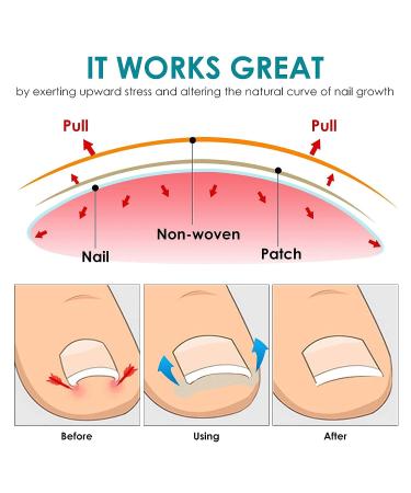 Professional Ingrown Toenail Treatment Kit - 60PCS Toenail Corrector Strips, File, and Lifter - Painless Pedicure Tool for Ingrown Toenails - Buy Online on GoSupps.com
