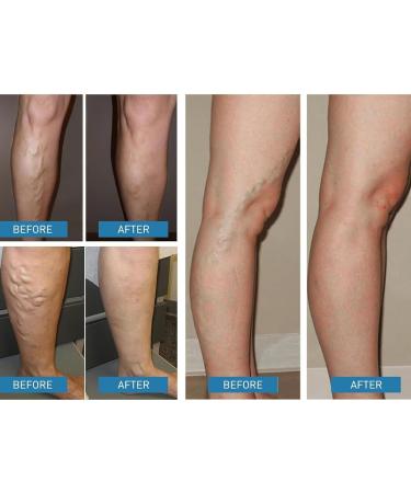 Soothing Leg Balm - Plant Extract 100g Moisturizing Cream for Circulation for Men Women and Adults - Vein Discomfort Prolonged Standing Daily Care - Buy Online on GoSupps.com