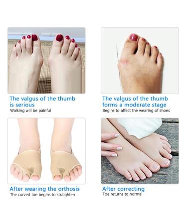 YUYTE Hallux Valgus Corrector Orthotic Braces for Bunion Alignment [Large] - Toe Separator for Men and Women - Buy Online on GoSupps.com