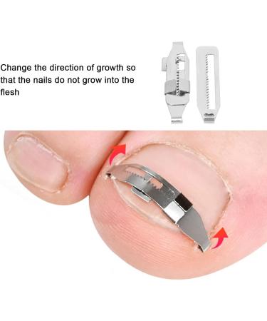 Ingrown Toenail Tool Effective Correction Wearable Stainless Steel Clip Buckle Relieve Pain Stainless Steel - Buy Online on GoSupps.com