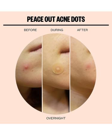 PEACE OUT Clear Skin Duo: Hydrocolloid Anti-Acne Patches + Retinol Face Strips for Pore Minimization and Blackhead Removal - Buy Online on GoSupps.com