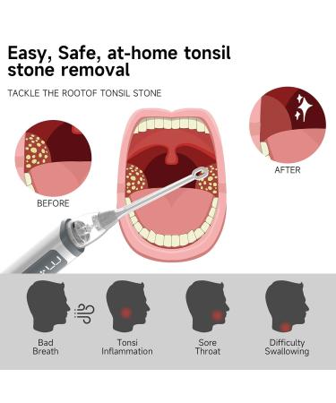 Electric Tonsil Stone Remover Kit - 5 Silicone Tips 3 Suction Levels Rapid USB-C Charging Integrated LED - Gentle & Painless for Home Use Doctor Recommended - Buy Online on GoSupps.com