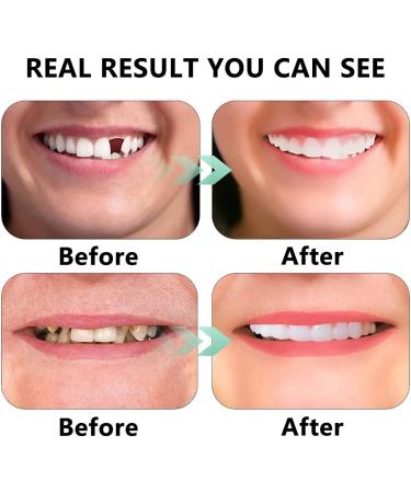 Dazzluxe Instant Veneers Dentures - 2 Pair Comfort Fit Cosmetic Temporary Teeth for Men & Women - Cover Missing Teeth - Buy Online on GoSupps.com