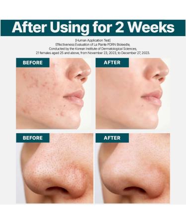 MD'S PICK LA Plante PDRN Hyaluronic Bioleedle Serum - Vegan Pore-Tightening & Hydrating Anti-Aging Serum | Korean Skin Care - 1 Million Shots - Buy Online on GoSupps.com