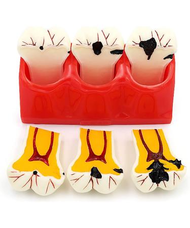 Buy Samnuerly 4-Fold Dental Teeth Caries Model - Removable Tooth Pathology & Evolutionary Display for Dental Training | International Shipping Available - Buy Online on GoSupps.com