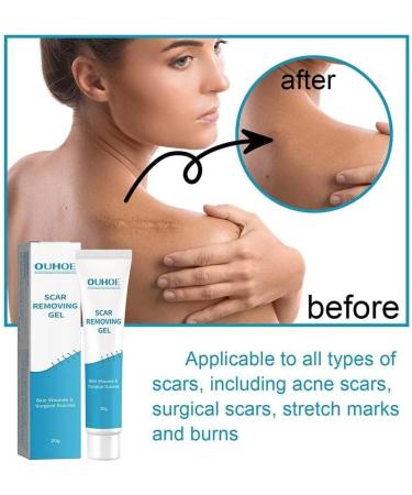 WWDZ Scar Removal Cream Gel - 2pcs Set for Repairing Pock Marks, Burns, Surgical Scars, and Cesarean Scars - Stretch Mark Treatment and Skin Moisturizer - Buy Online on GoSupps.com
