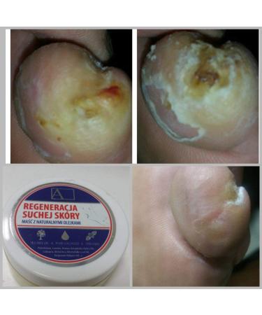 Arkada Skin Ointment Antibacterial Cream Antifungal Moisturizing For Nails Feet Hands And Elbows - Buy Online on GoSupps.com