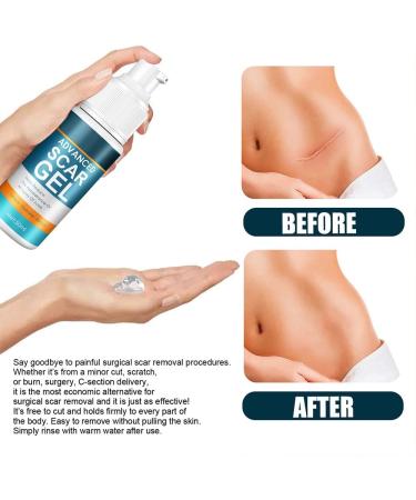 Scar Removal Cream Gel - Natural Extract for Brightening & Reducing Surgical Scars - Buy Online on GoSupps.com