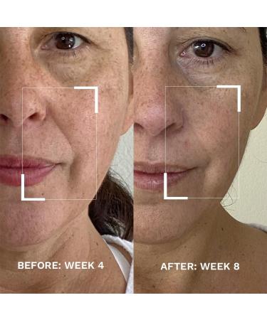 City Beauty Ultra-Fill Marionette Line Treatment | Anti-Aging Solution for Wrinkles Around Nose Mouth & Chin | Reduce Laugh Lines & Smile Lines - Buy Online on GoSupps.com