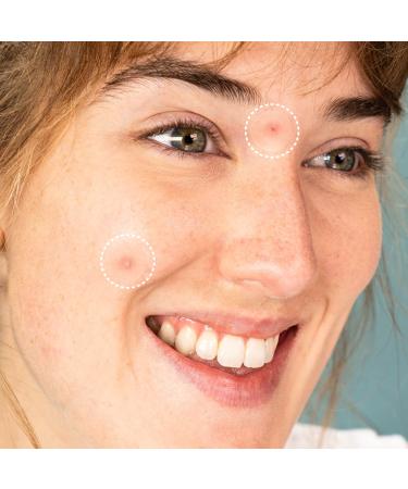 FaceTory Spot Fighter Acne Blemish Patches (150 Count) | Hydrocolloid Day & Night Patches for Acne Spot Treatment - 2 Sizes | AM & PM Assortment - Buy Online on GoSupps.com