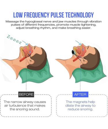 Smart Anti Snoring Device - Automatic Silent Snore Stopper & Nasal Congestion Relief - Buy Online on GoSupps.com