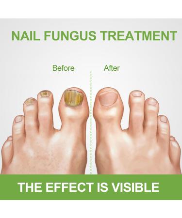  Sikeydels Foot Nail Care Nourish and Soothe Nails Strengthens Nail Structure Nail Treatments with 1 Nail File 30ml - Buy Online on GoSupps.com