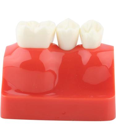 Implant Model Resin Dental Demonstration Demonstration Tooth Model Teeth Model Science Homework for Teaching Model School Dentist - Buy Online on GoSupps.com