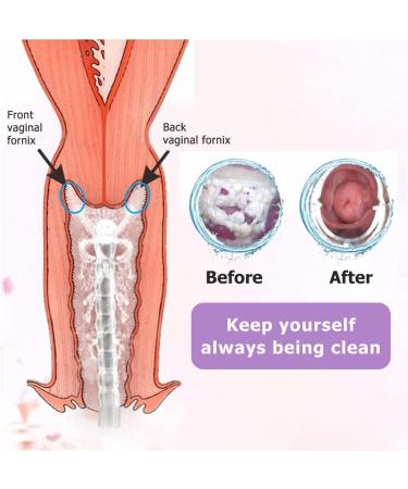 300ml Reusable Vaginal Cleansing System with 3 Nozzle Tips - Vaginal & Anal Douche Kit for Men and Women - Manual Pressure Enemas for Vagina Cleaning - Buy Online on GoSupps.com