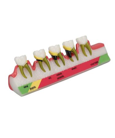 Model for dental periodontitis model for dental teeth for studying model for dental periodontitis from synthetic resin in different stages