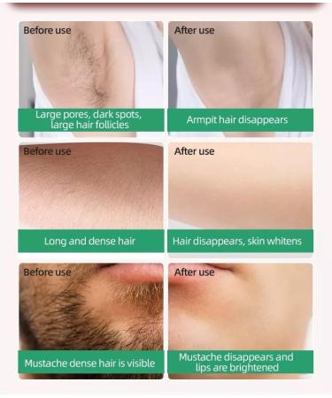 Laser Hair Removal for Women - Permanent Painless IPL Device with 999,999 Flashes, 5 Energy Levels, 2 Modes - Ideal for Face, Body, Bikini - Deep Green - Buy Online on GoSupps.com