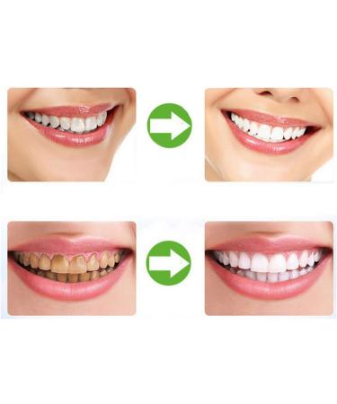 Silicone Teeth Whitening Trays - Use with Lamp & Bleaching Gel | Dental Grade, 5PCS - Buy Online on GoSupps.com