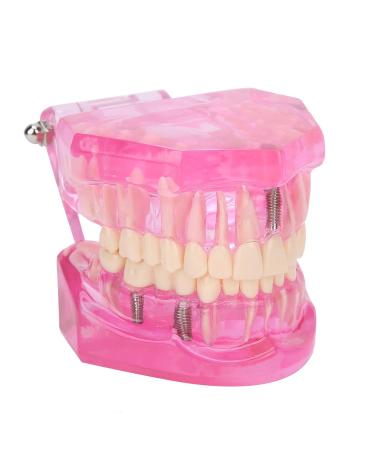 Transparent Adult Teeth Model - Pathological Removable Dental Teaching Tool Standard Size - Ideal for Study & Repairs - Buy Online on GoSupps.com