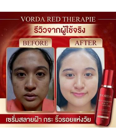 Vorda Red Therapie Serum Facial 30ml - Korean X50 Photoglow for Radiant Skin | International Shipping - Buy Online on GoSupps.com