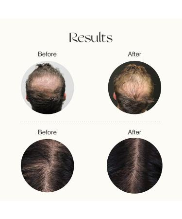 Buy Advanced Hair Growth Serum for Men & Women | Redensyl Anagain Procapil & Rice Water - Boost Hair Growth & Prevent Thinning for All Hair Types - Buy Online on GoSupps.com