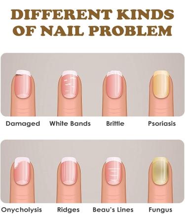 NailGrowth DeepHealing Organic Serum NailGrowth Nail Serum Reconstrux Nail Growth Nail Growth and Strengthening Serum Nail Serum for Growth and Repair for Damaged Nails (3pcs) - Buy Online on GoSupps.com