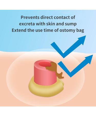 Stoma Skin Barrier Ostomy Paste - Protective Adhesive Skin Protectant - 2 oz Ostomy Supplies for Optimal Skin Care - Buy Online on GoSupps.com
