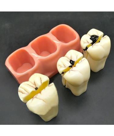 Buy Samnuerly 4-Fold Dental Teeth Caries Model - Removable Tooth Pathology & Evolutionary Display for Dental Training | International Shipping Available - Buy Online on GoSupps.com