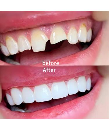 Moldable False Teeth 30ML Temporary Tooth Filling Kit for DIY Teeth Tooth Repair Kit Filling Replacement Dental Repair for Fake Teeth Dental Tooth Filler for Restoring Your Smile - Buy Online on GoSupps.com