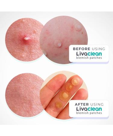 Livaclean (120 Count 3 Pack) Mixed bundle of Regular (48) Salicylic Acid (36) and T.Tree (36) Hydrocolloid Patches + 10 Count Large Square Patches 130 Count Mixed Pack - Buy Online on GoSupps.com