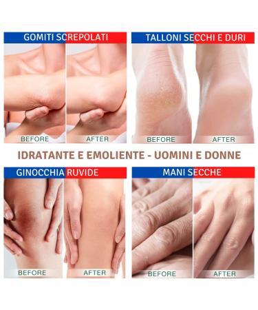 TIS CREME with 15% Urea - Eczema Psoriasis Dry Skin Relief | Wound Healing for Hands Feet Knees & Nails | 50 ml Pack - Buy Online on GoSupps.com